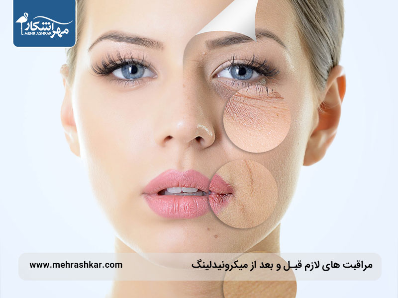 مراقبت‌ های لازم قبل و بعد از میکرونیدلینگ
