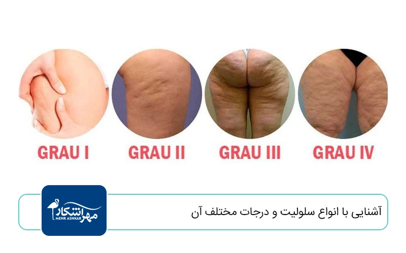 آشنایی با انواع سلولیت و درجات مختلف آن