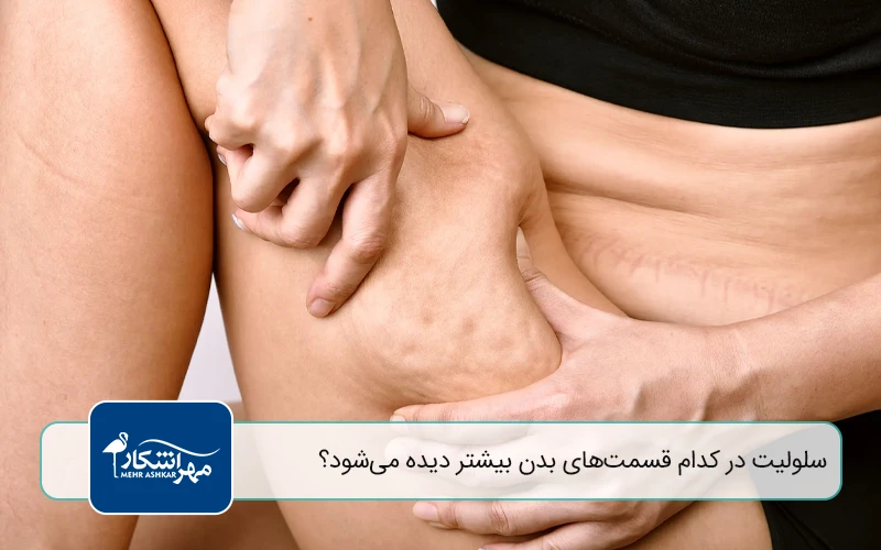 سلولیت چیست و دستگاه رفع سلولیت