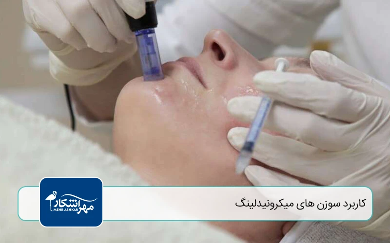 کاربرد انواع سوزن میکرونیدلینگ