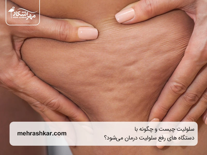 سلولیت چیست و دستگاه رفع سلولیت