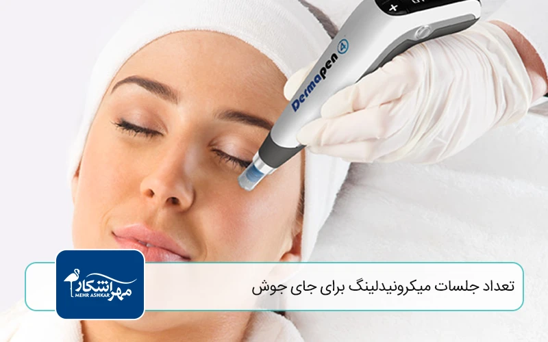 تعداد جلسات میکرونیدلینگ برای جای جوش