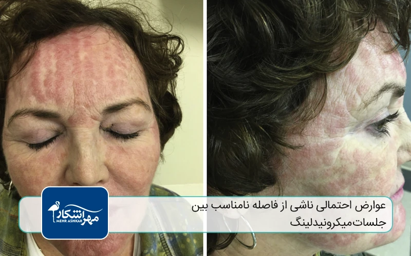 میکرونیدلینگ چیست و چگونه عمل میکند؟
