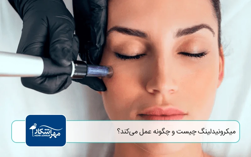 میکرونیدلینگ چیست و چگونه عمل میکند؟