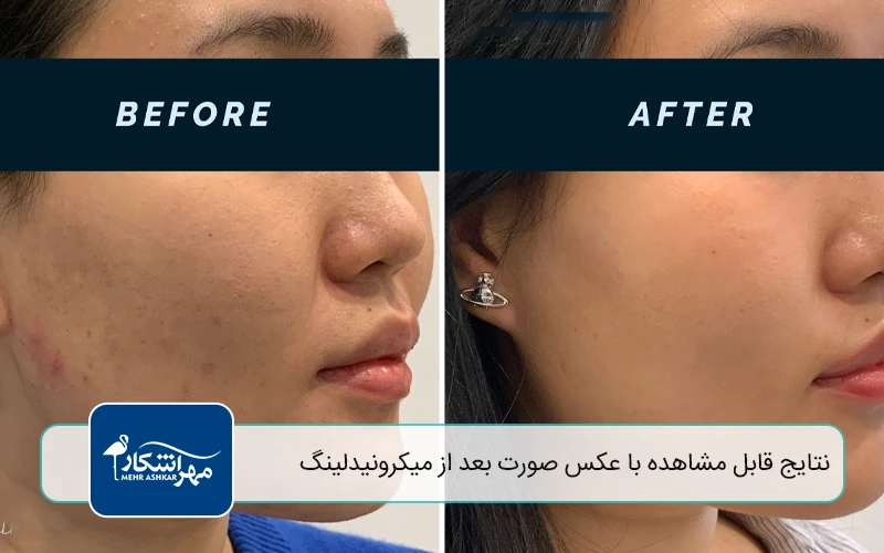 نتایج قابل مشاهده با عکس صورت بعد از میکرونیدلینگ
