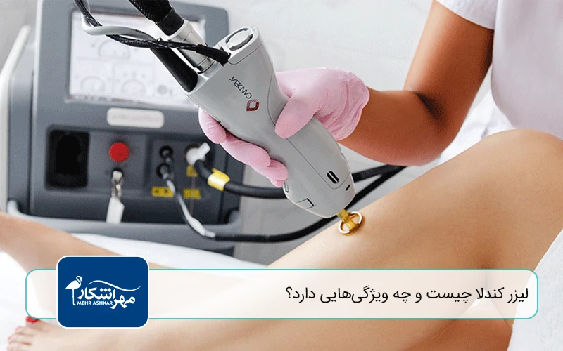 لیزر کندلا چیست و چه ویژگیهایی دارد؟