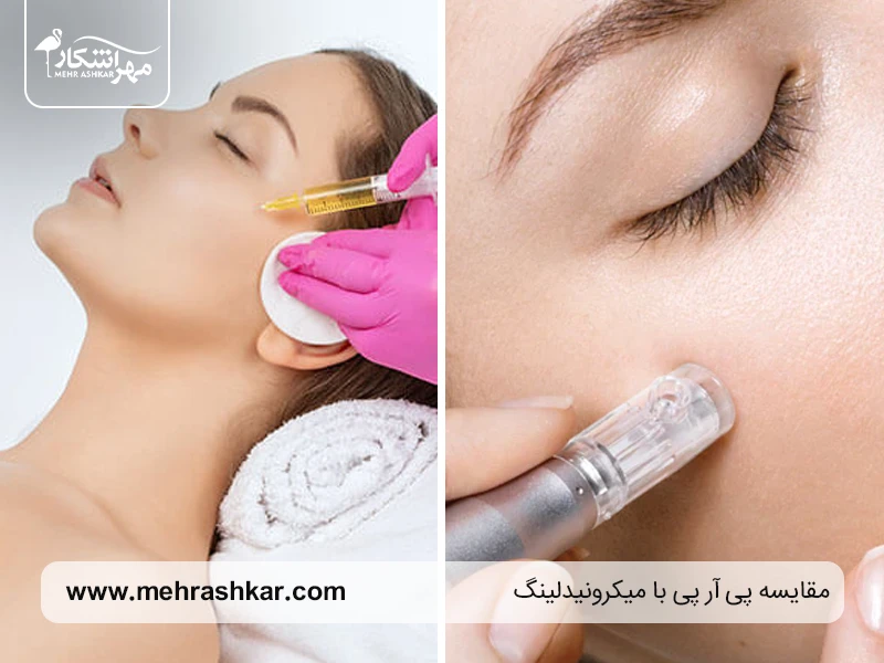 مقایسه پی آر پی با میکرونیدلینگ؛ کدام روش برای جوانسازی پوست بهتر است؟